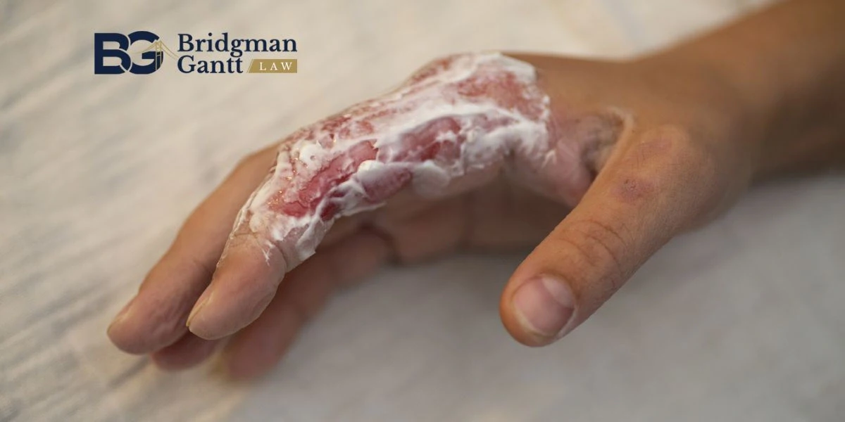 Gastonia Burn Injury At Work Lawyer