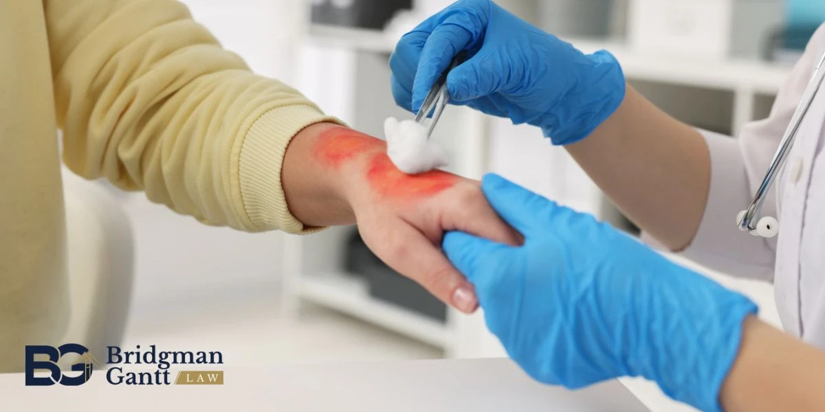 Shelby Burn Injury at Work Lawyer